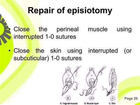 episotomy procedure and repair techniques obgyndo com