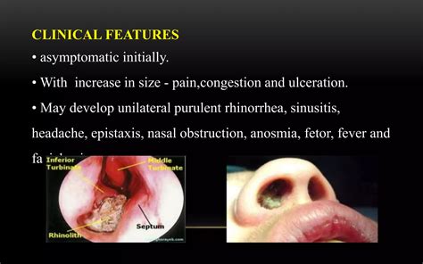 Epistaxis With Headache