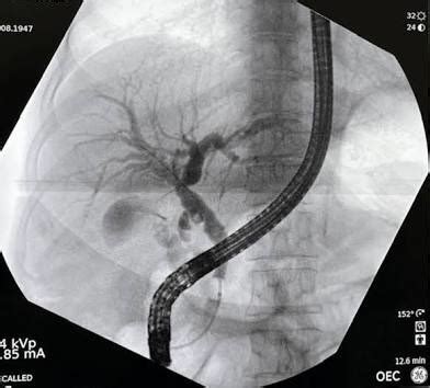 Ercp Sonrası ölüm
