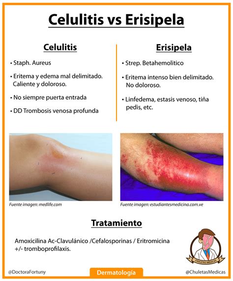 Erisipela Vs Celulitis