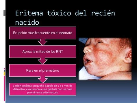 eritema toxico del recien nacido tratamiento pdf