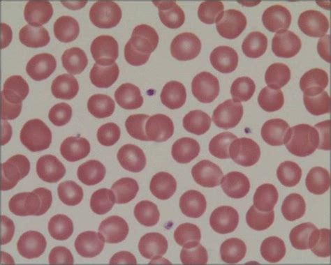 eritrosit normal | Berapa Hemoglobin Eritrosit dan Hematokrit normal B