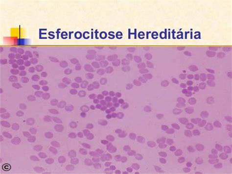 esferocitose-4