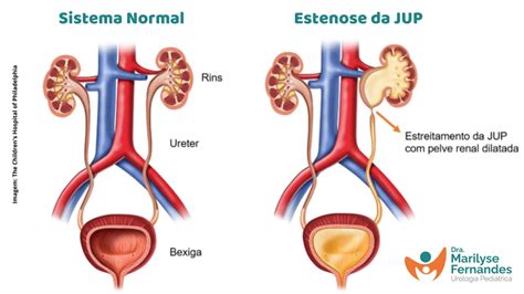 Estenose De Jup