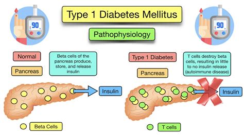 ETIOLOGI DIABETES MELITUS：Diabetes - Wikipedia