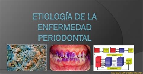 etiologia de la enfermedad periodontal slideshare