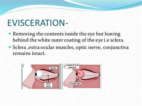 Eviscerate Definition
