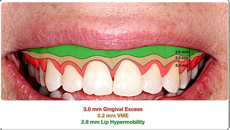 Excessive Gingival Display With Recessed Chin Deformity