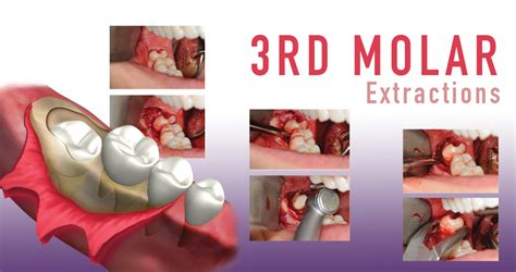 Download Expert Third Molar Extractions 