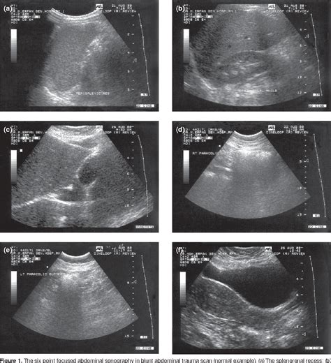 extended Focused Abdominal Scan for Trauma …