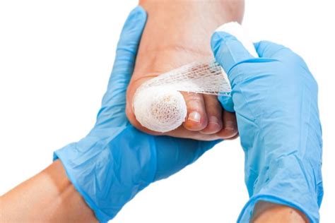 Extensor Tendon Lengthening Cpt
