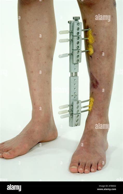 External Fixator Tibia