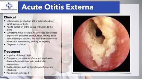 External Otitis Media