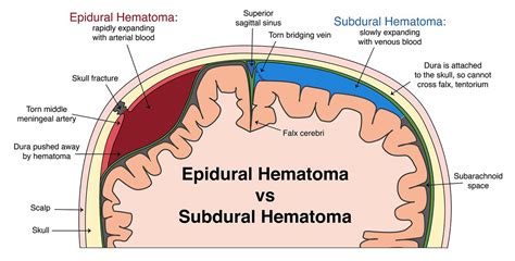 Extradural And Epidural