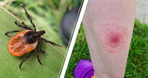 fästing borrelia inkubationstid