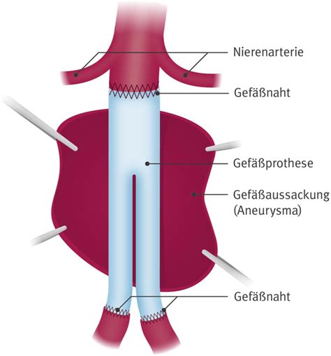 förstorad aorta operation