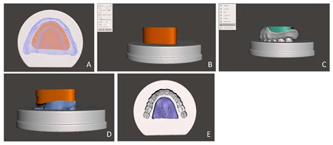Read Online Fabrication Of Complete Dentures Using Cad Cam Technology 