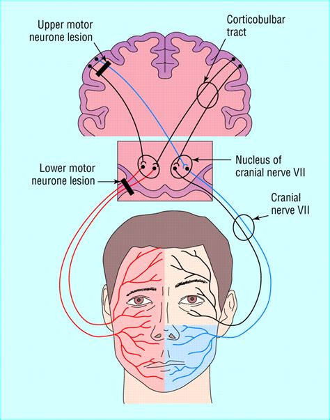 Facial Nerve Palsy Diagram