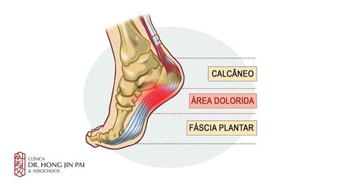 facite plantar