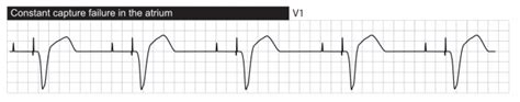 Failure To Capture Pacemaker
