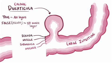 False Diverticulum Examolpes