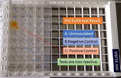 False Negative Hiv Elisa Test Hiv Dr Tan And Partners