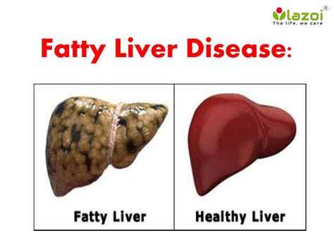 fatty liver adalah