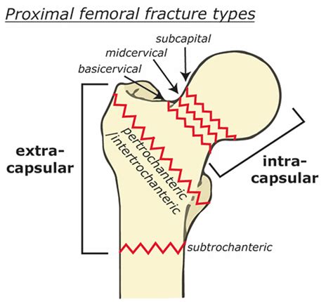 Femoral Head Fracture