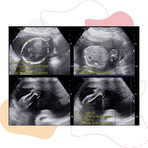 FETOMATERNAL ADALAH - USG Fetomaternal adalah pemeriksaan kehamilan