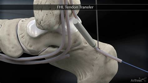 Fhl Tendon Transfer Cpt