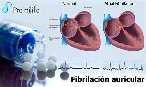 fibrilacion