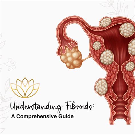 Fibroids Master Secrets To Getting Rid Of Fibroid