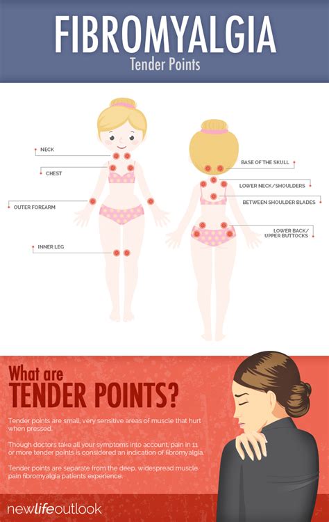 Fibromyalgia Pressure Point Chart