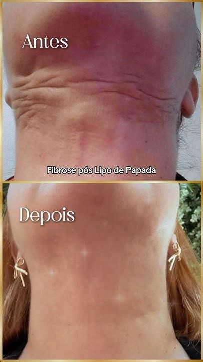 Fibrose Pos Lipo