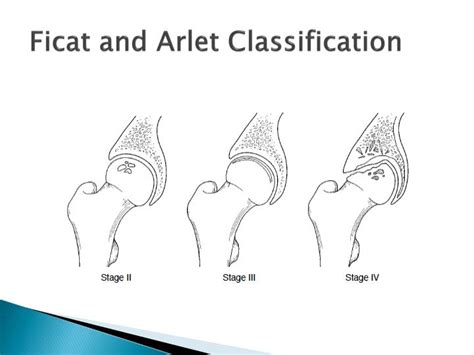 Ficat And Arlet Classification