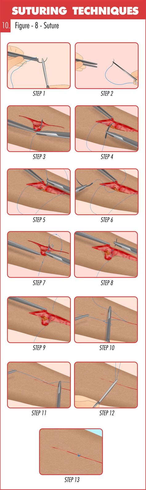 Figure Of Eight Suturing