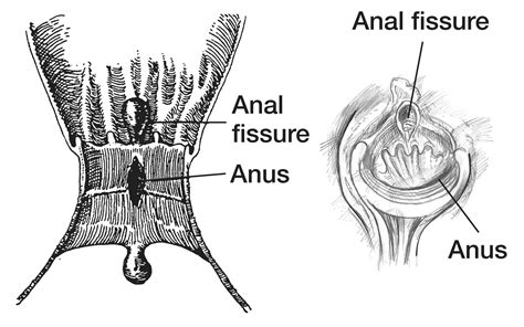 fisura anus