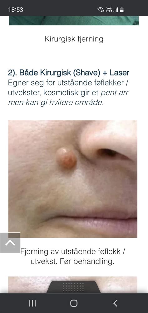 flagnat i ansiktet