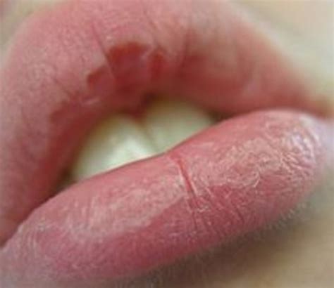 flaky lips