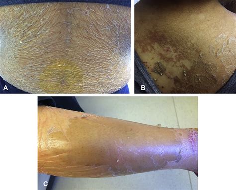 Flaky Paint Dermatosis