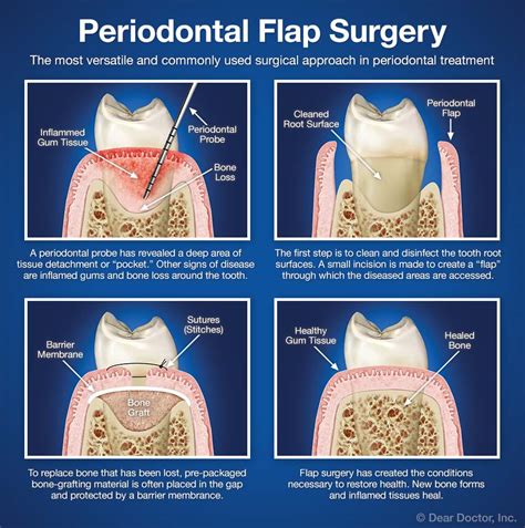 Flap Surgery Dental