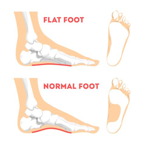 flat foot