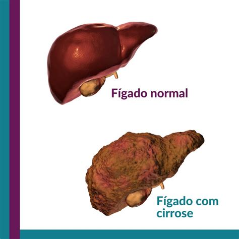 Flebólitos E Câncer