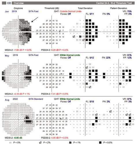 flickering light in eyesight