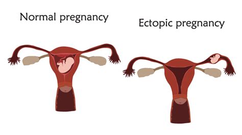 florida ectopic pregnancy