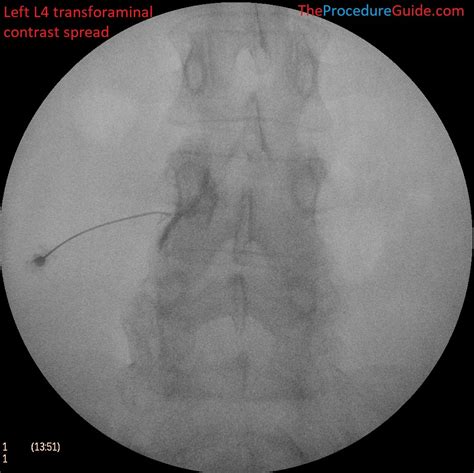 Fluoroscopic Guided Injection