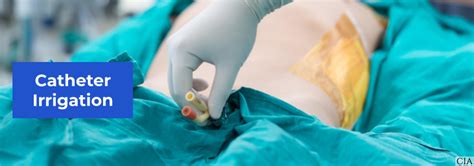 Flushing A Foley Catheter
