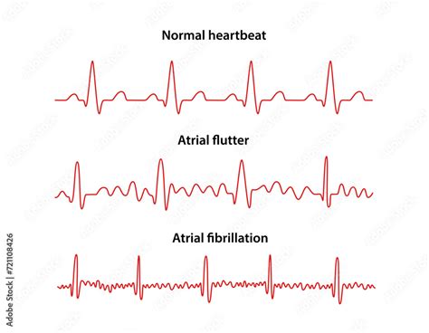 Flutter And Fibrillation