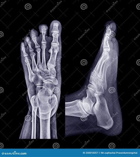 Foot Ap Lat
