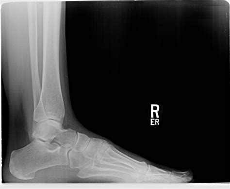 foot lateral x ray